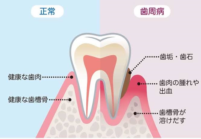 歯周病と定期検診の重要性について